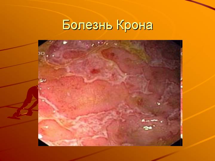 Болезнь Крона