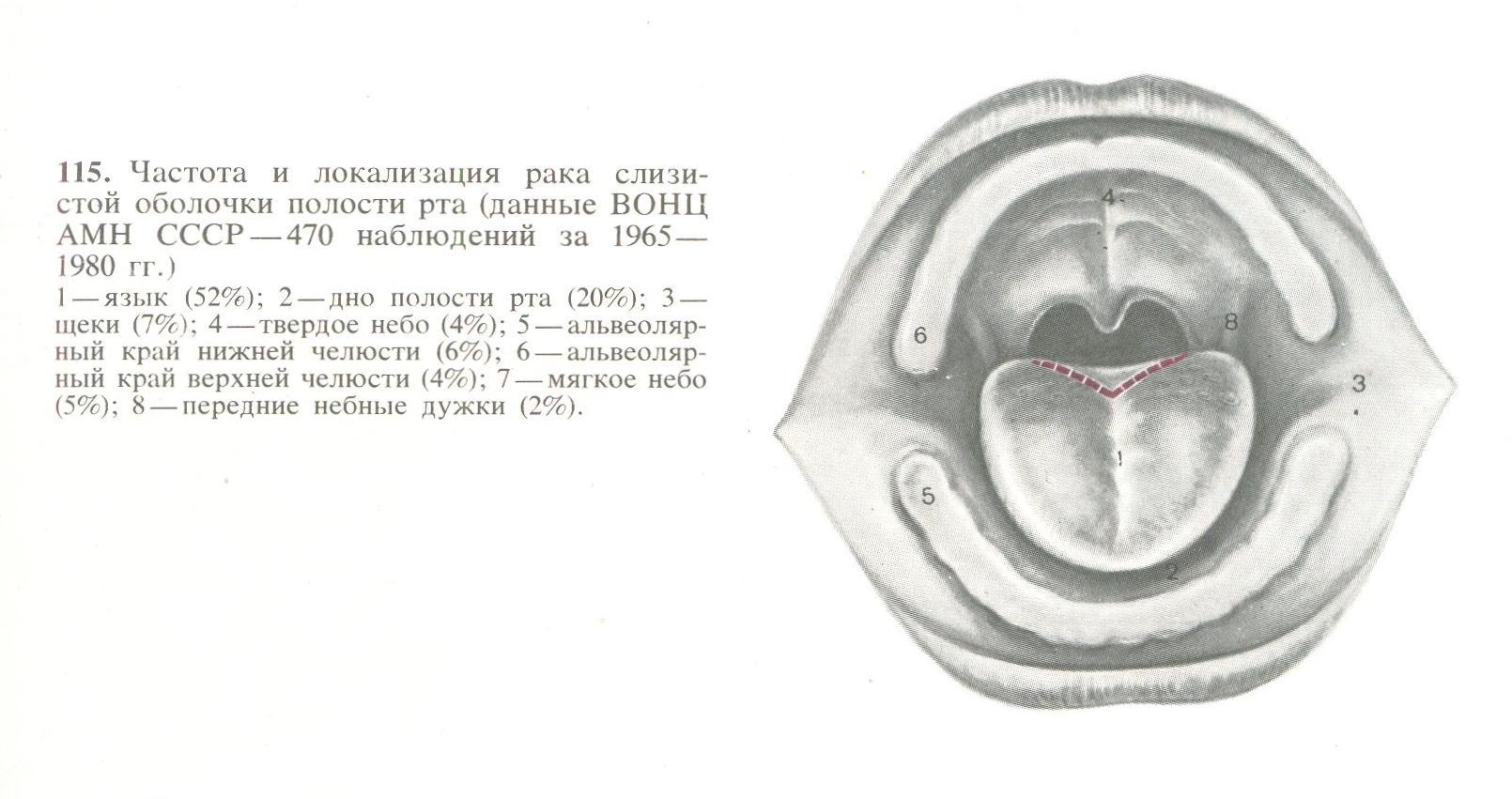 Рак слизистой рта
