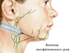 лечение лимфомы ходжкина