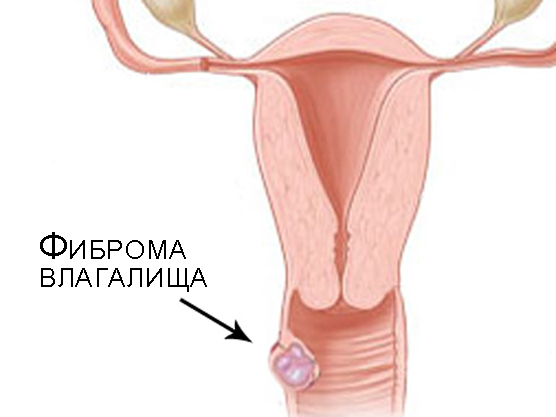 Фиброма влагалища