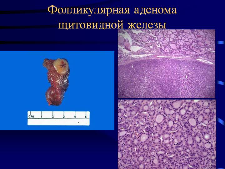 Фолликулярная аденома щитовидной железы
