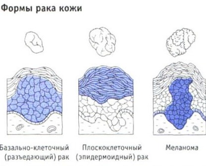 Рак кожи