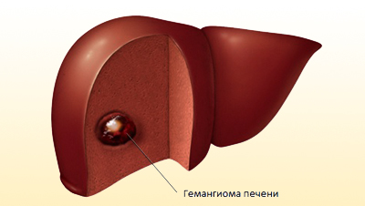 Гемангиома печени