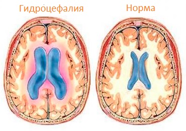 Опухоль эпифиза