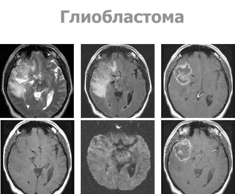Глиобластома