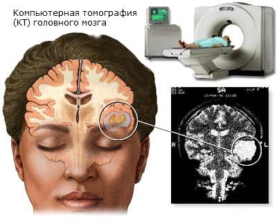 Опухоль головного мозга .Сколько с ней живут?
