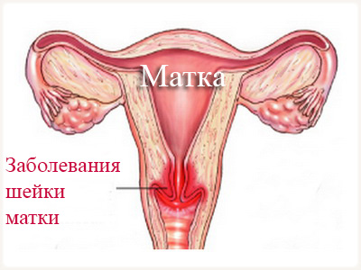 Карцинома ин ситу