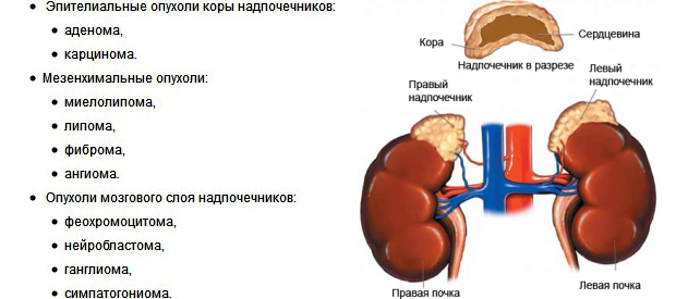 Опухли надпочечников