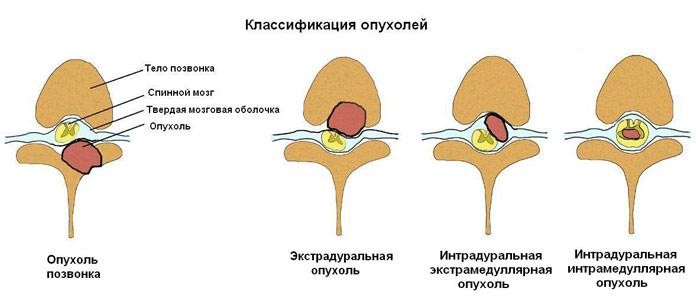 Опухоль спинного мозга