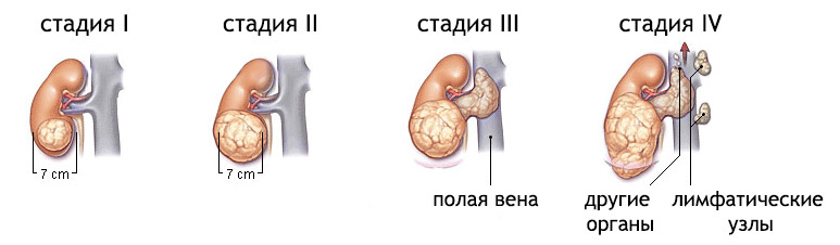 Рак 4 степени с метастазами.Сколько живут?