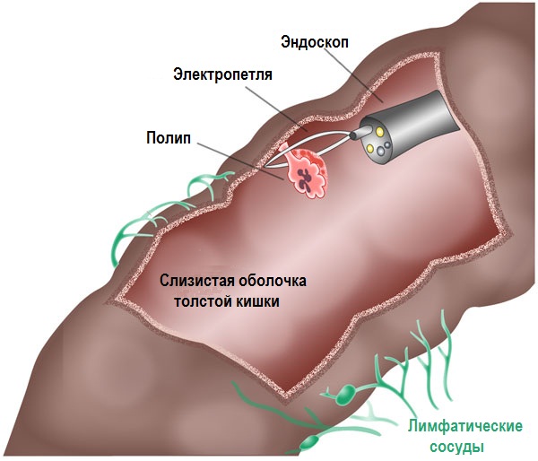 Рак слепой кишки