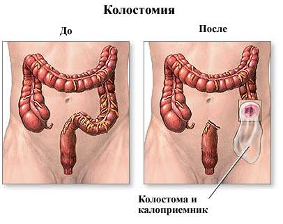 Колостома