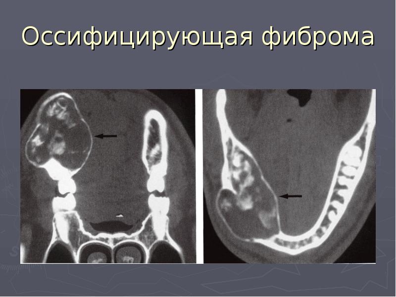 Компьютерная томография фибромы