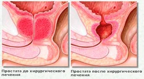 Чем лечить аденому простаты у мужчин?