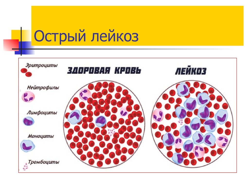 Лимфобластная бластома