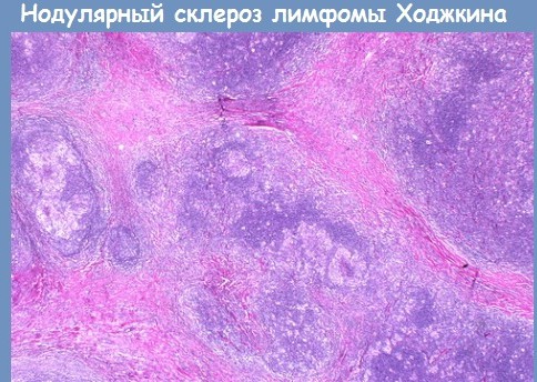 Лимфома Ходжкина нодулярный склероз