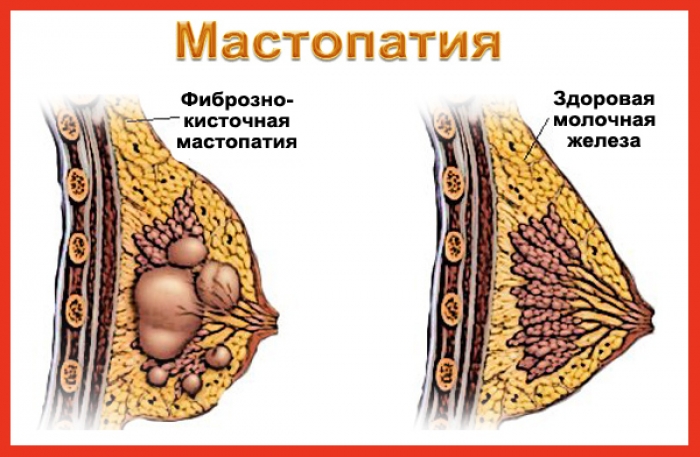 Фиброматозный узел
