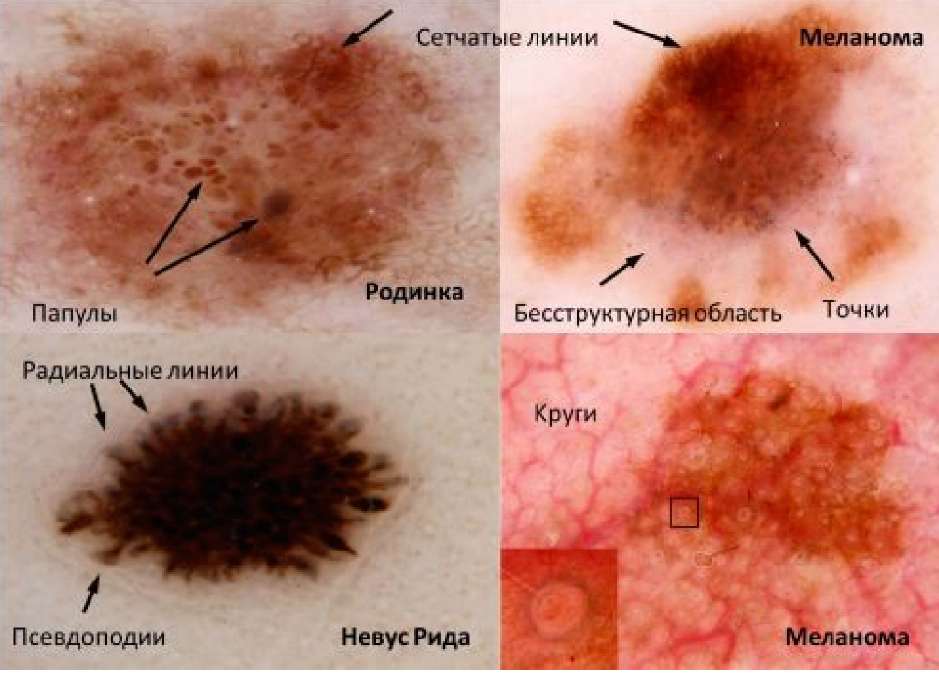  Дерматоскопия