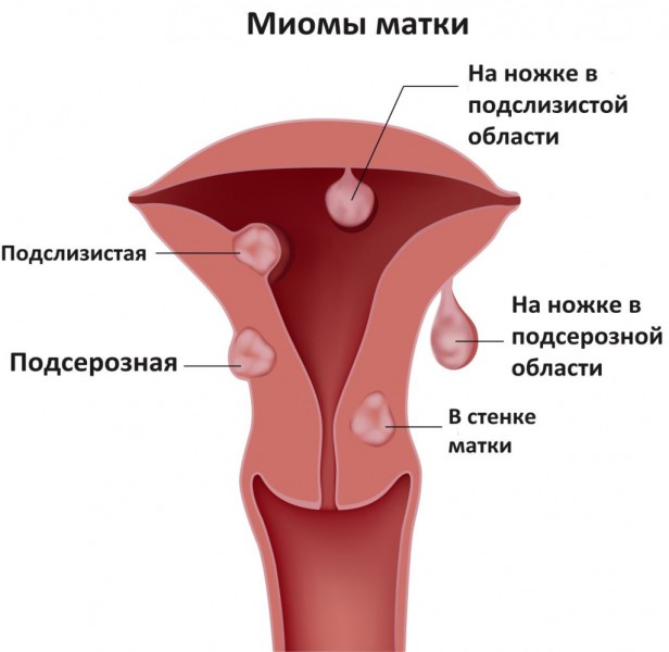 Миомы-матки
