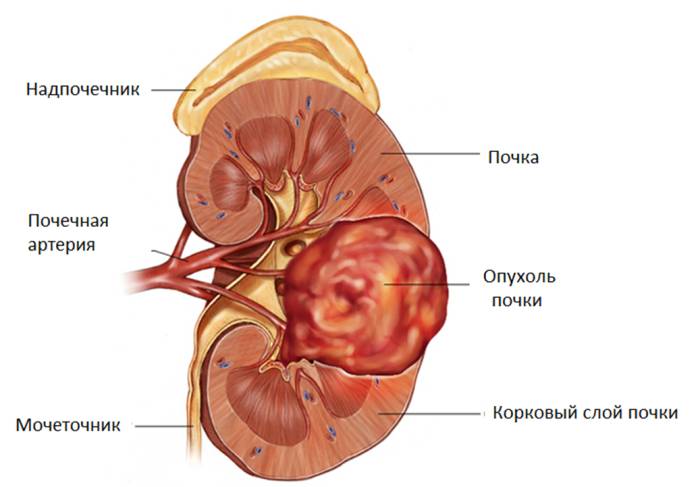 Опухоли почек