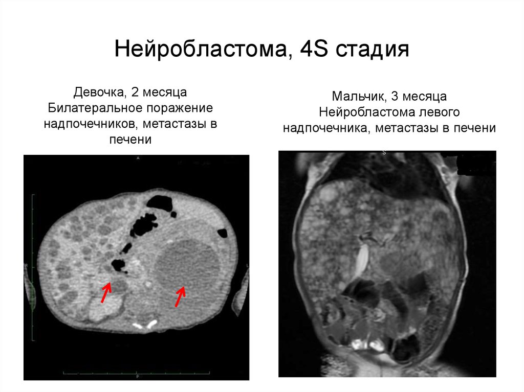 Нейробластная бластома