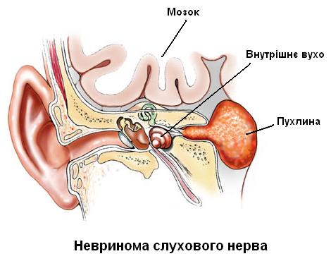 Опухоли основания черепа