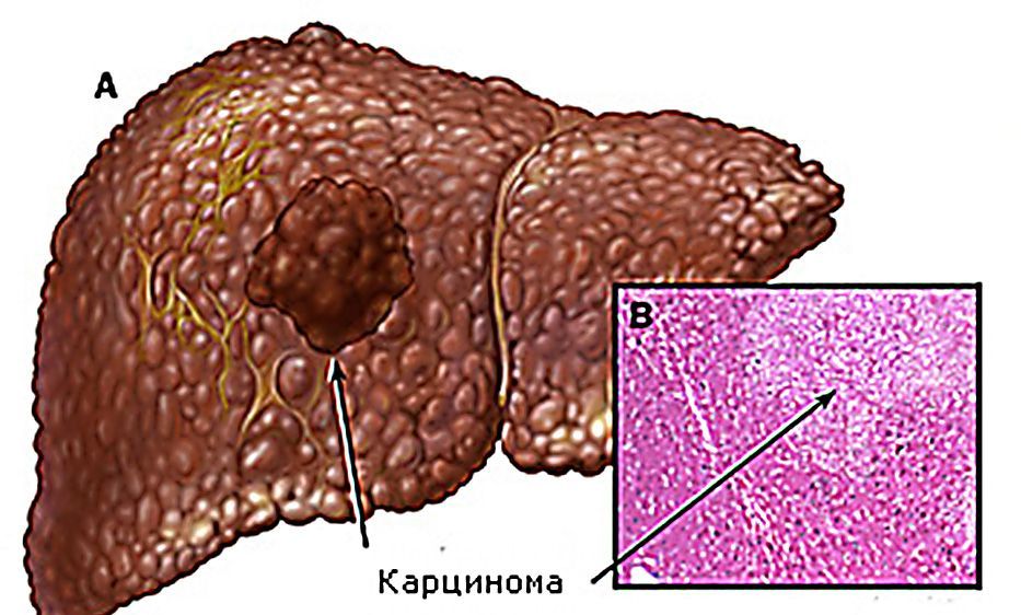 Карцинома печени.Симптомы