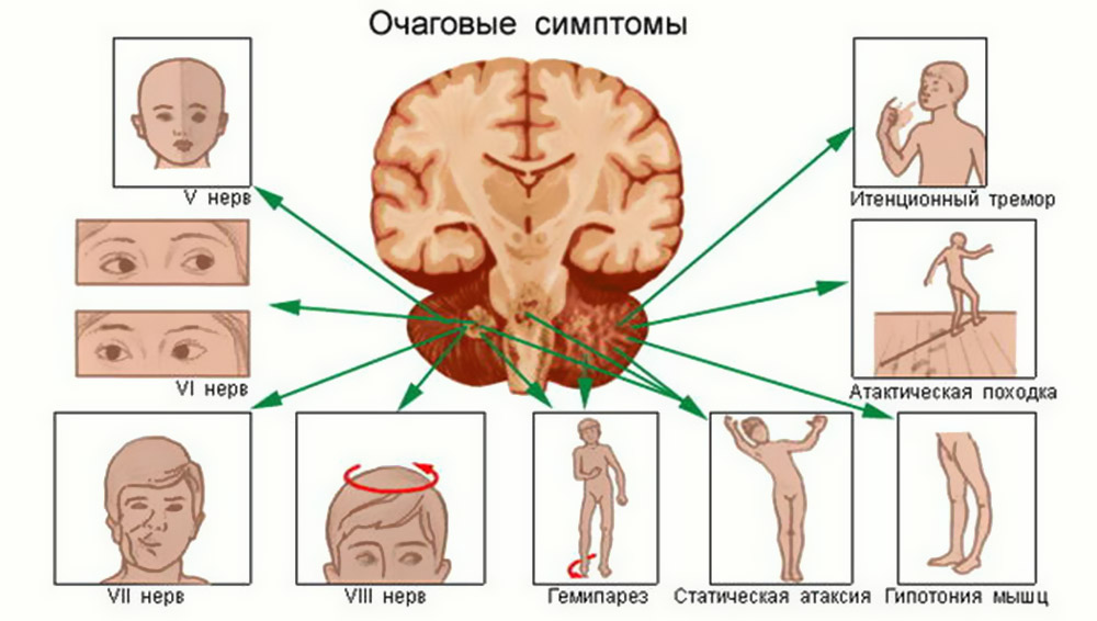 Опухоль мозжечка