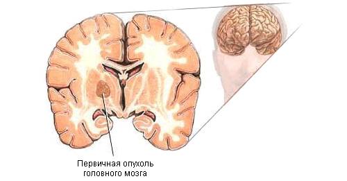 Опухоль головногно мозга