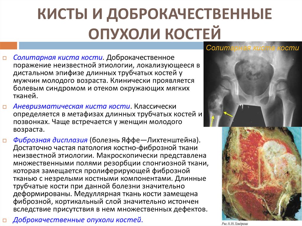 Бластома костей