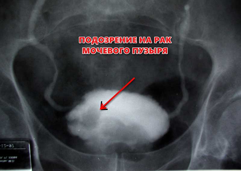 Что такое бластома мочевого пузыря?