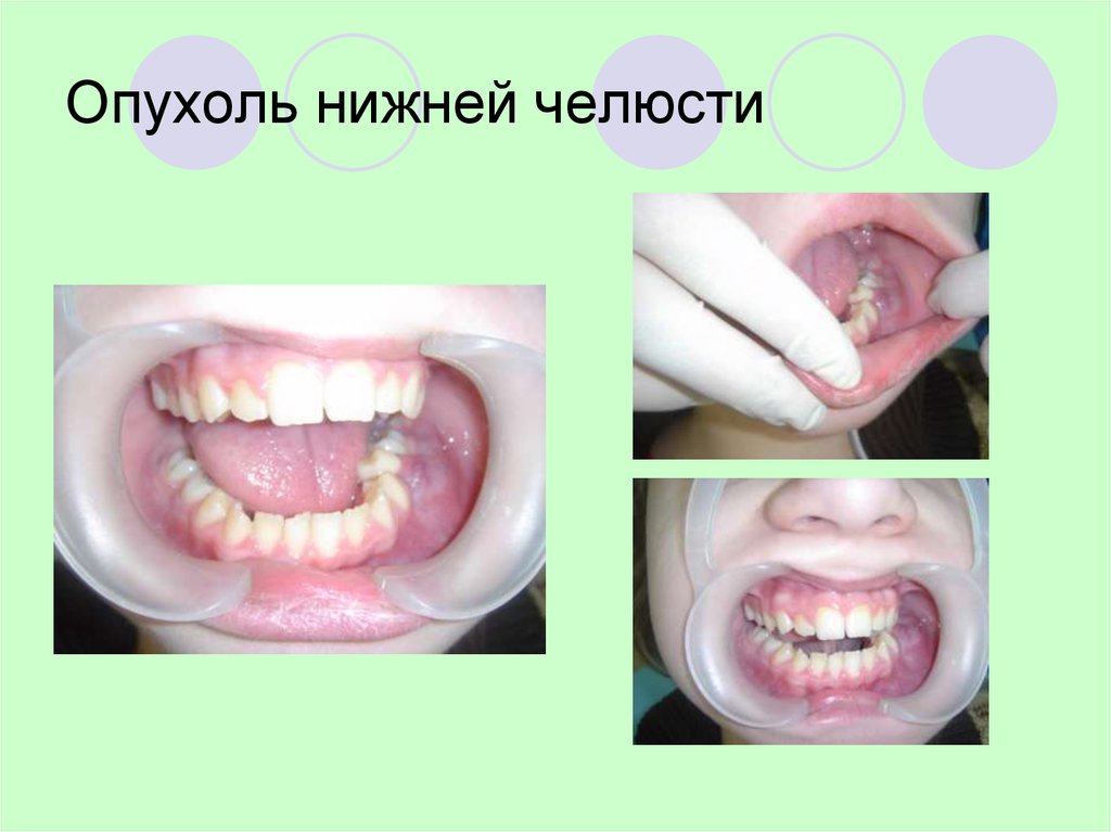 Бластома нижней челюсти