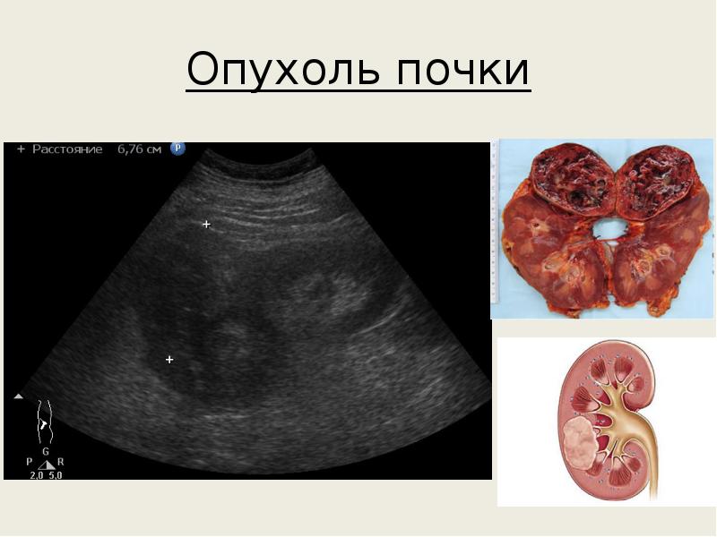 Бластома почки – что это такое?