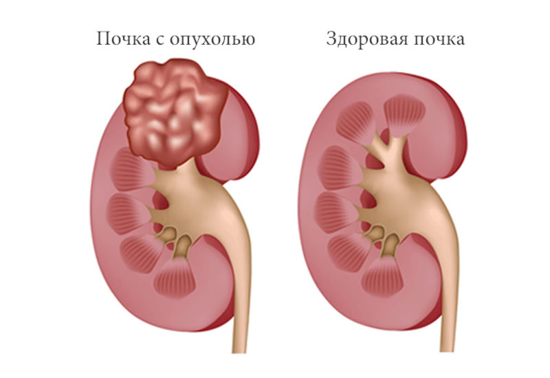 Опухоль почки