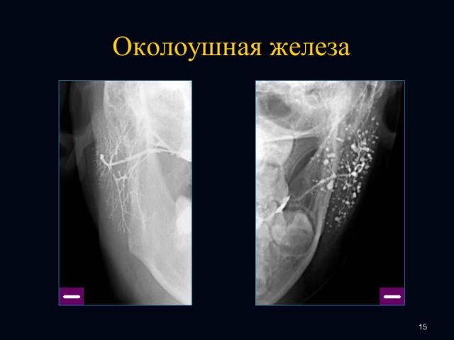 Опухоли слюнных желез