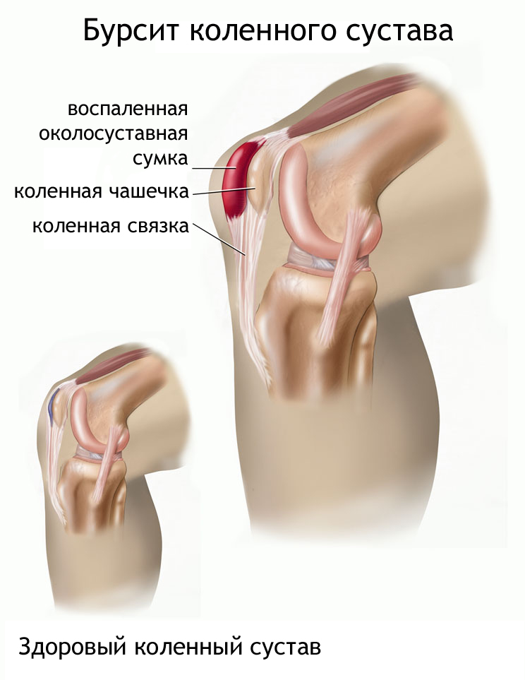 Опухоль в колене
