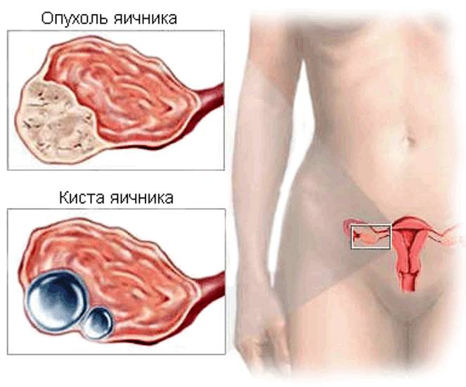 Опухоль яичников 