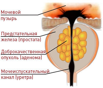 Опухоли предстательной железы.Аденома