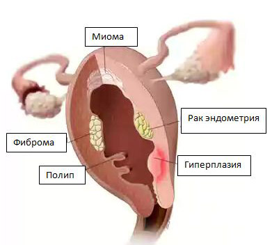 Фиброма матки