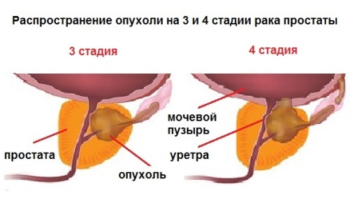 Рак простаты