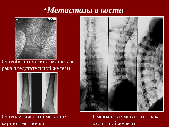 Остеобластические метастазы