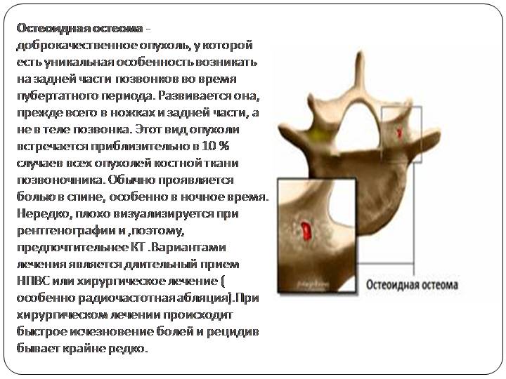 Остеоид - остеома
