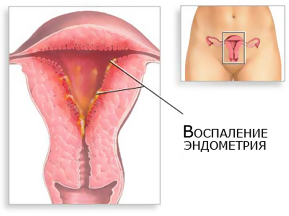 Рак эндометрия матки