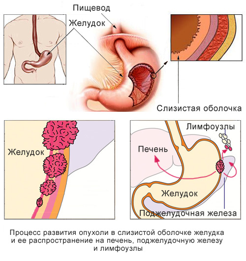 Перстневидноклеточная карцинома желудка