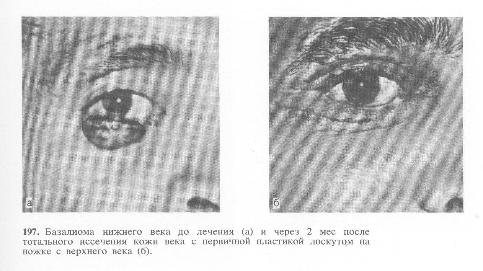 Пластика после иссечения базалиомы века