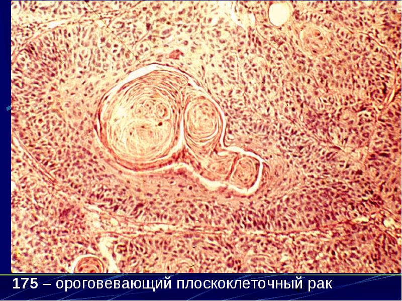 Плоскоклеточная ороговевающая карцинома