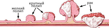 Полип на стенке органа