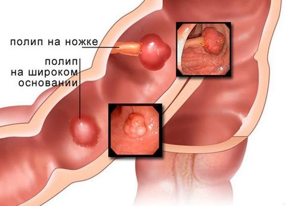 Опухли кшечника