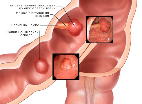 опухоль заднего прохода