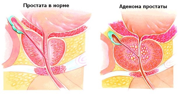 Препараты для лечения аденомы простаты пожилых